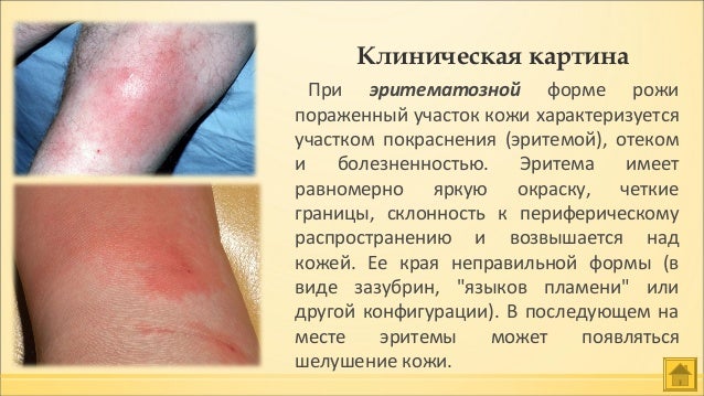 Что Такое Рожа Заболевание Фото Что Такое Рожа Заболевание Фото